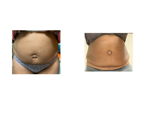 Laser Lipo and Lipo Cavitation